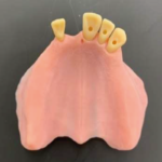 インプラント実習用歯科模型